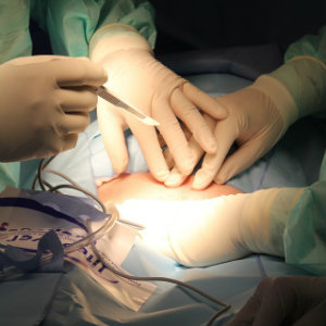 surgery for ovarian cancer