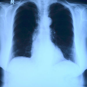 x-ray of a patient with possible lung cancer